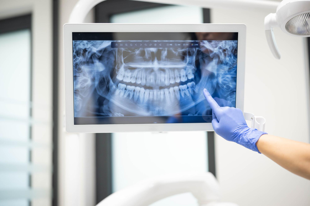 Immagine tridimensionale TC DentalScan per pianificare gli impianti dentali